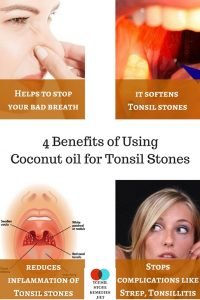 Coconut oil for Tonsil stones: Does oil pulling really eliminate your