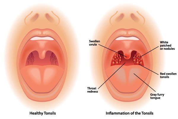 coconut oil for tonsil stones inflammation